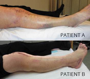 Pictures Of Bruising After Knee Replacement Surgery The Meta Pictures