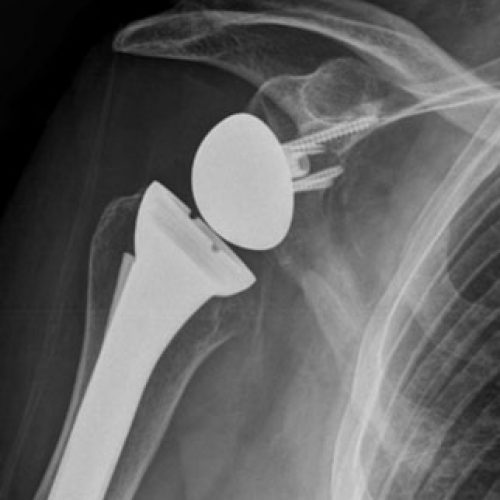 Shoulder Surgery Surgeons & Physicians Ballarat OSM