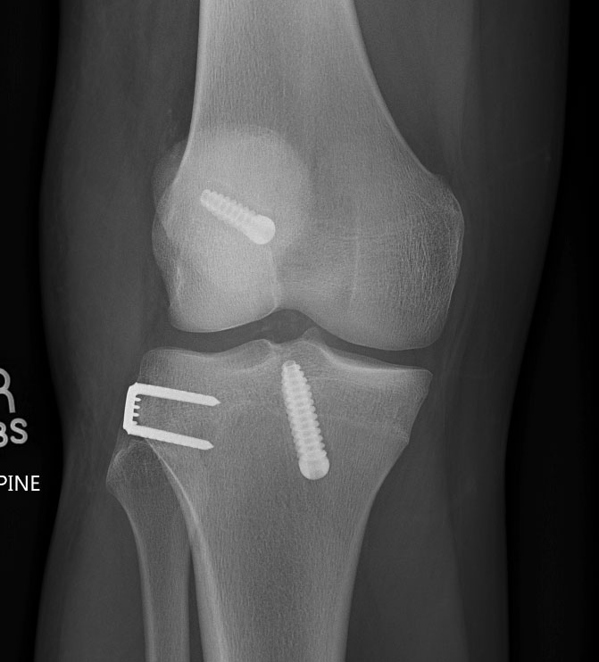 ACL Reconstruction Your Surgeon Should Be Considering Adding An Extra 