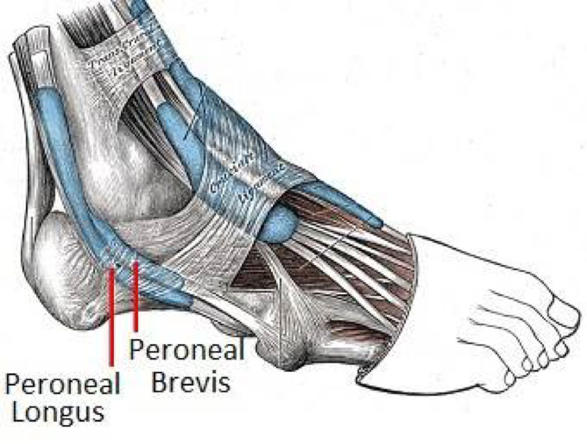 peroneal-tendon-injury-with-ganglion-cyst