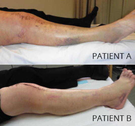 Bruise on female skin. Injection bruises after Pulmonary Embolism